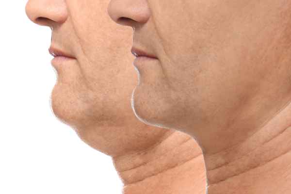 HIFU - Breakthrough in Anti - ageing 2 hifu results Hampshire