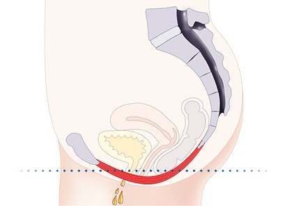 Pelvic-Floor Muscle Repair 5 Pelvic floor muscles Hampshire