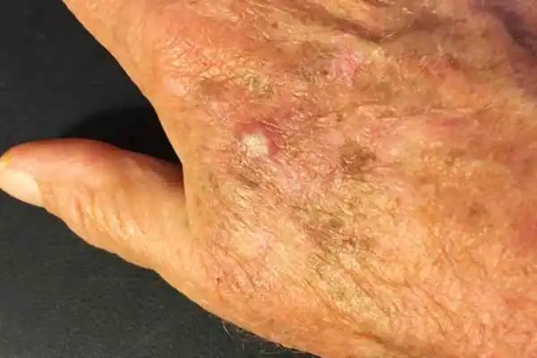 Image of Actinic keratoses Hampshire on a person hand