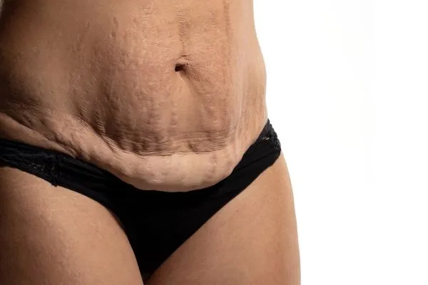 The science behind skin tightening Hampshire picture of a woman's sagging skin on the stomach